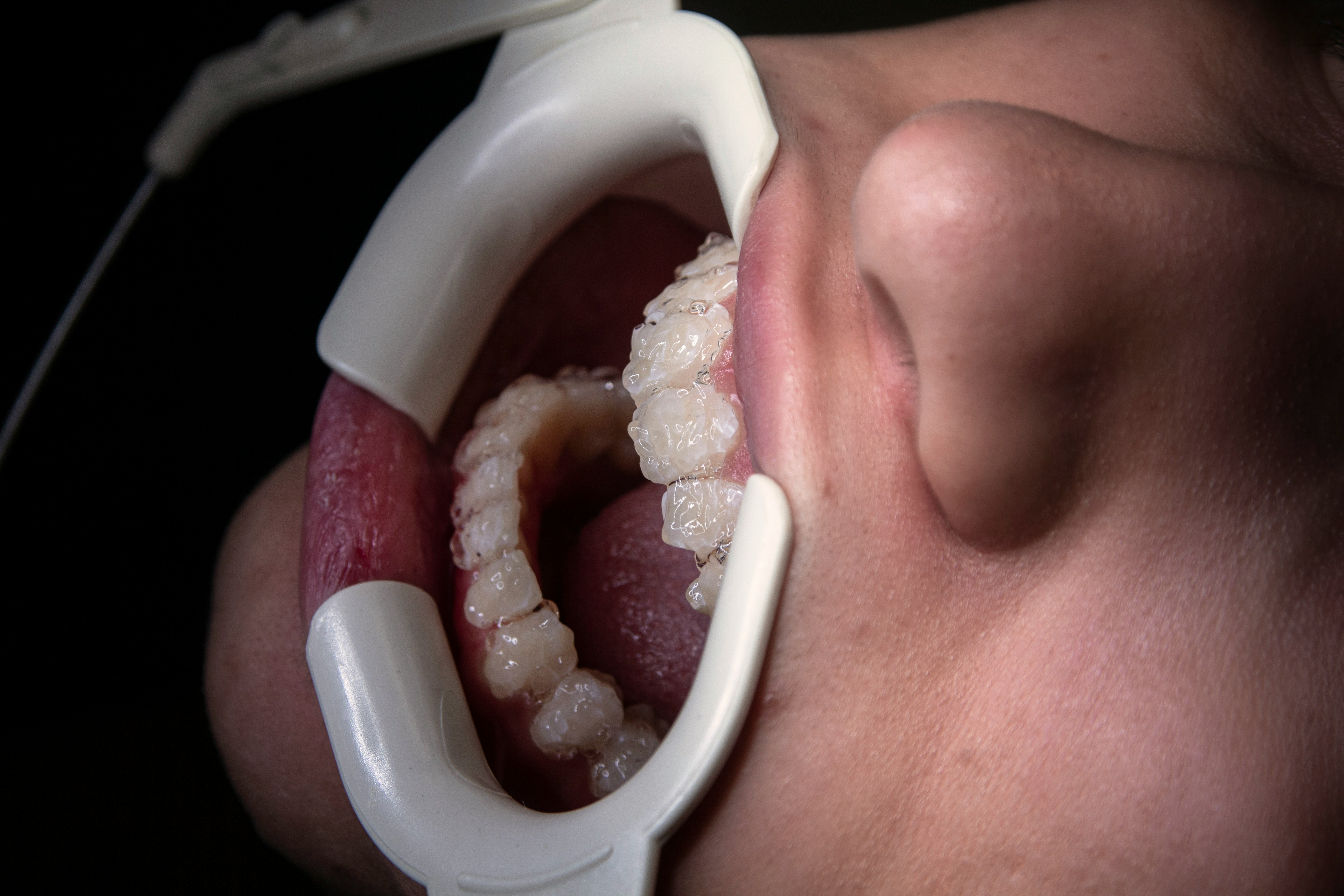 🦷 Diş Beyazlatma: Gerçekler ve Yanılgılar