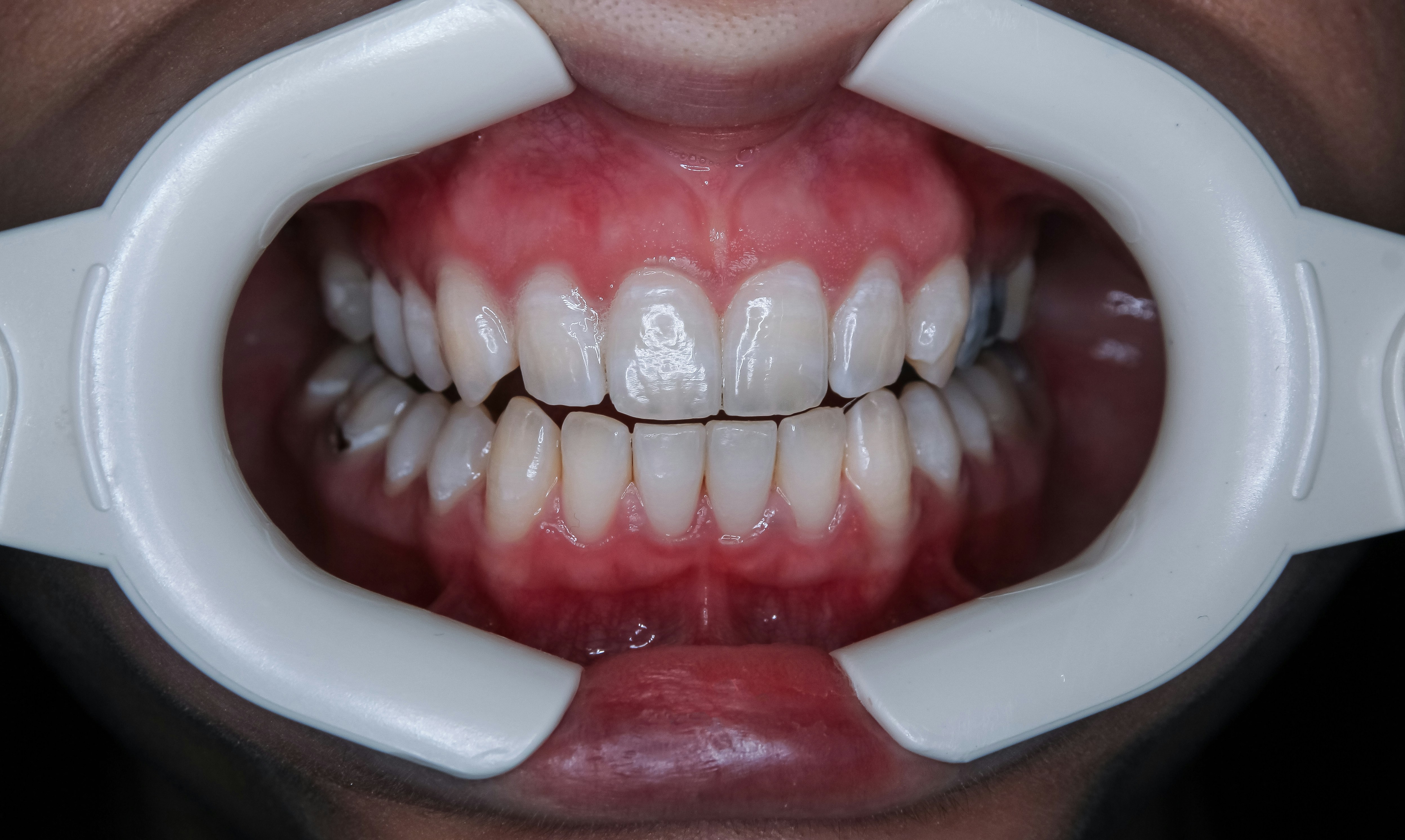 The Power of Preventive Dentistry: Why Regular Check-Ups Matter
